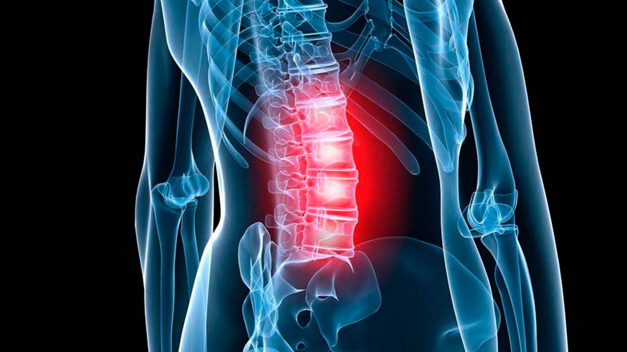 sintomas de osteocondrose lombar