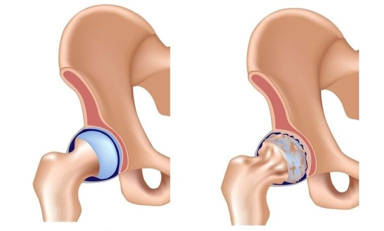 Articulação saudável e artrose com artrose