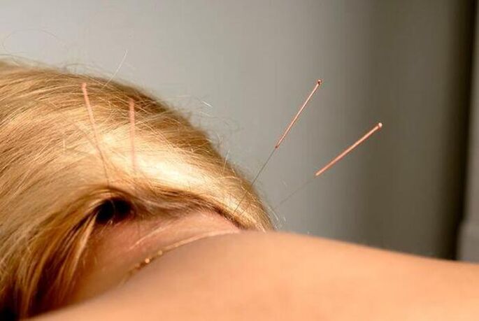 acupuntura para osteocondrose