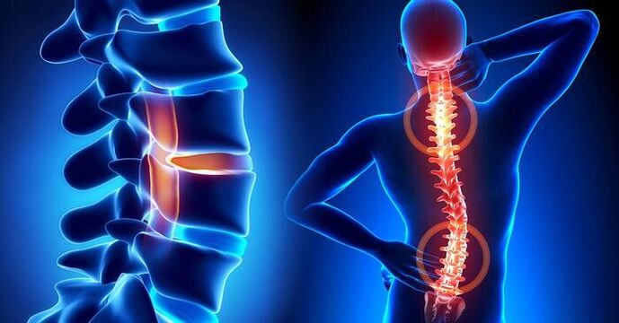 localização da dor na osteocondrose