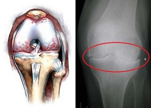 osteoartrite da articulação do joelho